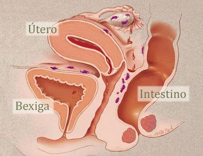 Endometriose endometriose